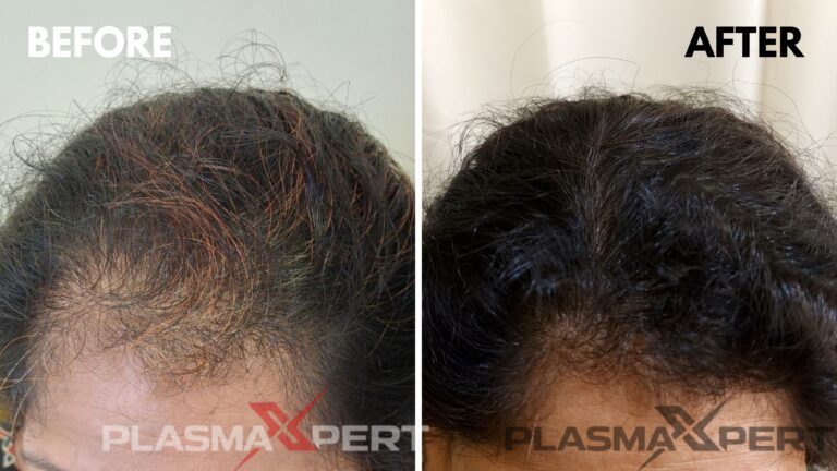 Advanced-hairloss-treatment-before after-plasmaxpert-Aluva-Angamaly-Perumbavoor