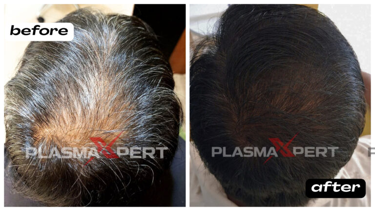 Advanced-hairloss-treatment-before after-plasmaxpert-Aluva-Perumbavoor