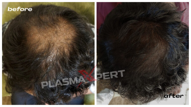 Advanced-hairloss-treatment-before after-plasmaxpert-Aluva-kakkanad