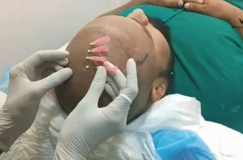 Scalp Thread Treatment